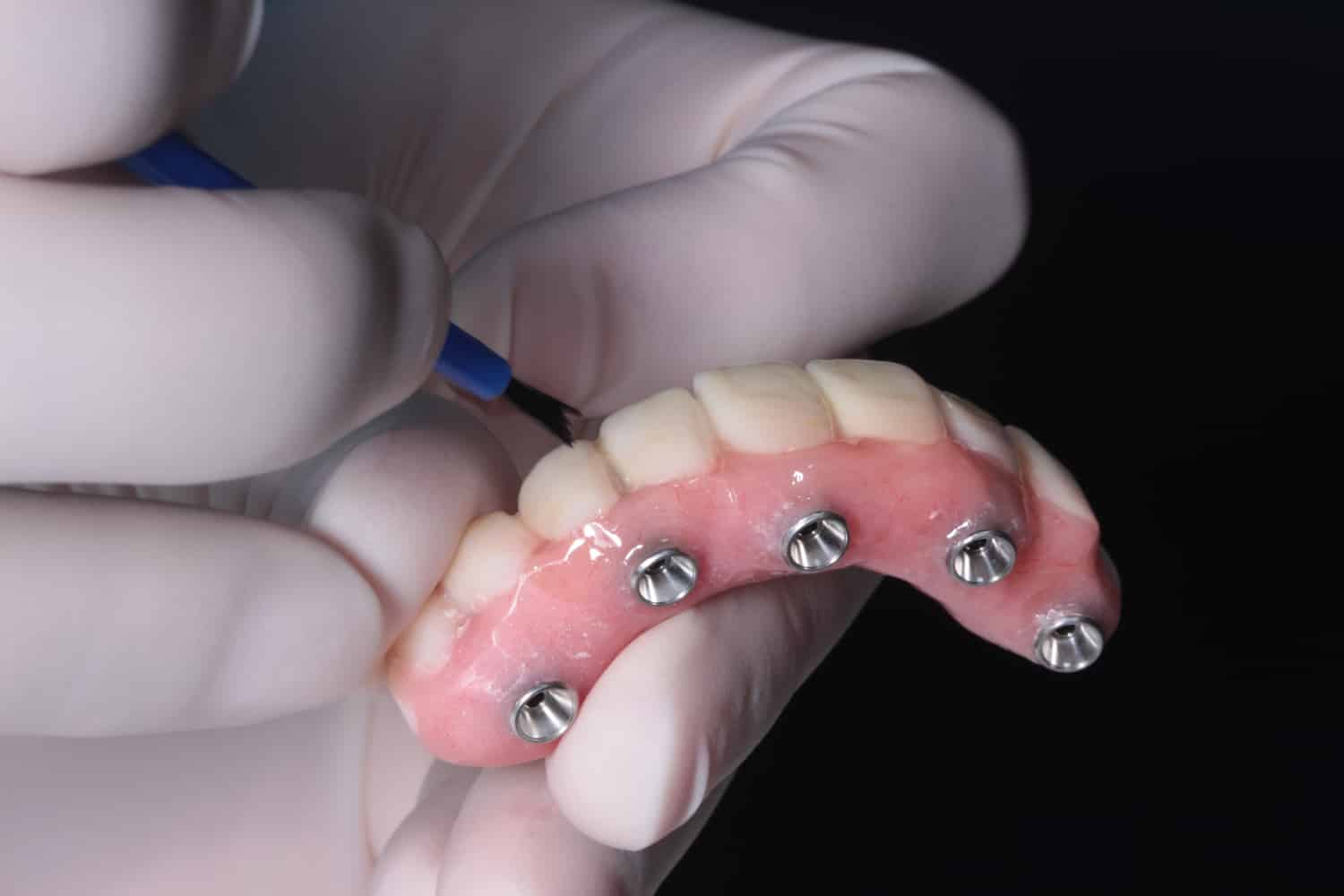implanted support dentures