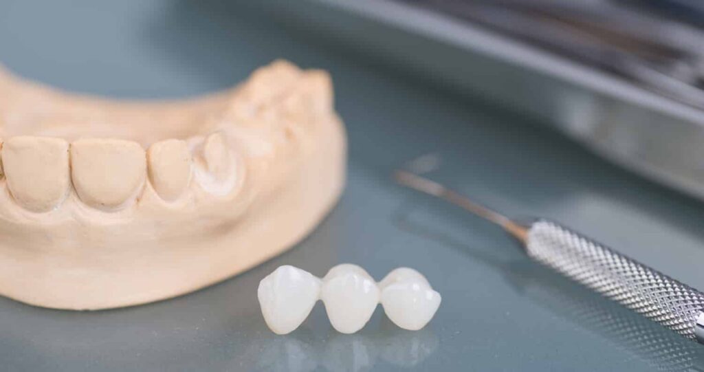 a dental bridge being created in a dental lab