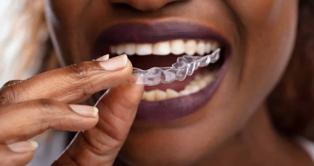 a woman putting night guard to prevent cracked teeth due to grinding