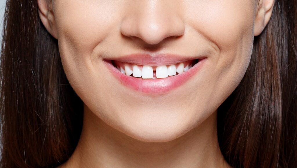 a woman with gap teeth wanting treatment at smith dentalworks