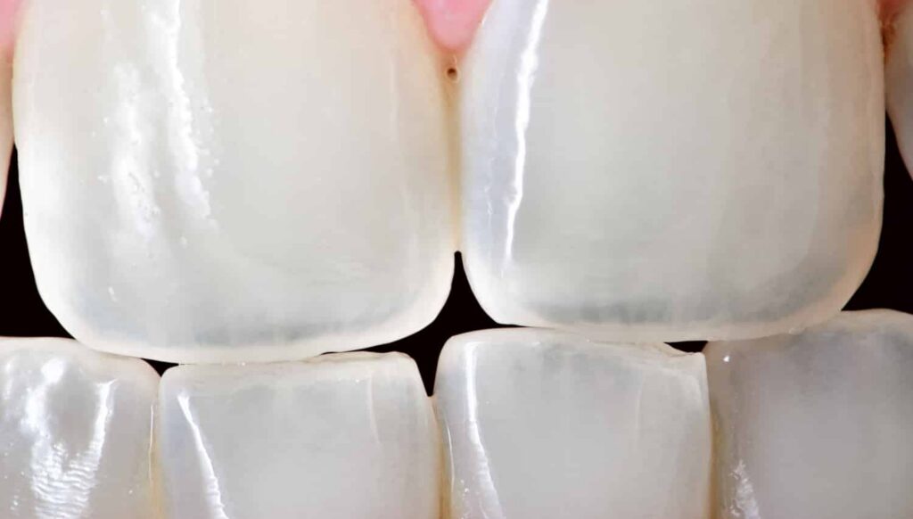 Close-up of teeth showing visible craze lines on the enamel, highlighting cosmetic dental concerns related to aging and wear.