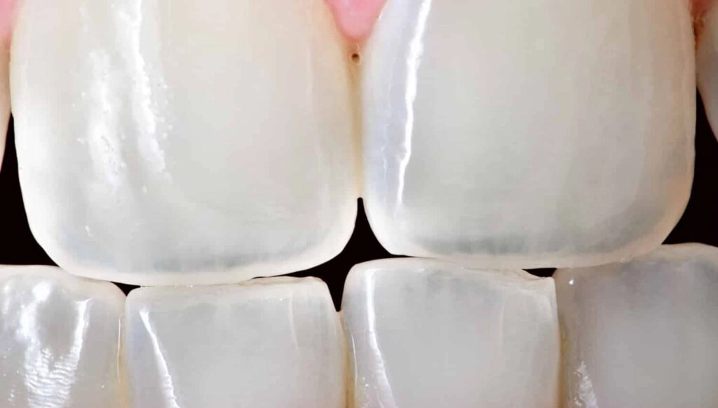 a close up of front teeth with minor craze lines