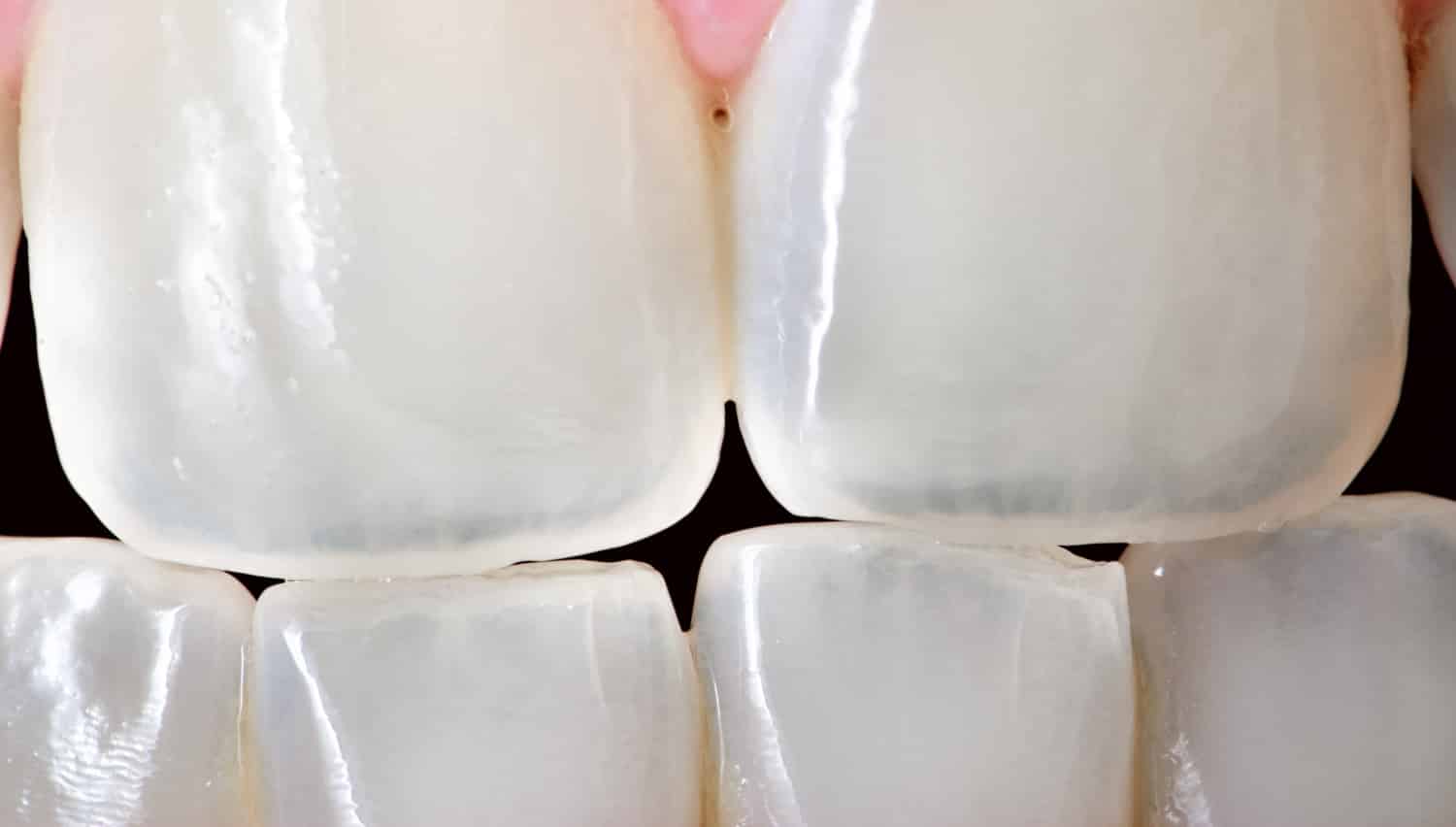 Craze Lines Cracked Teeth Veneers 