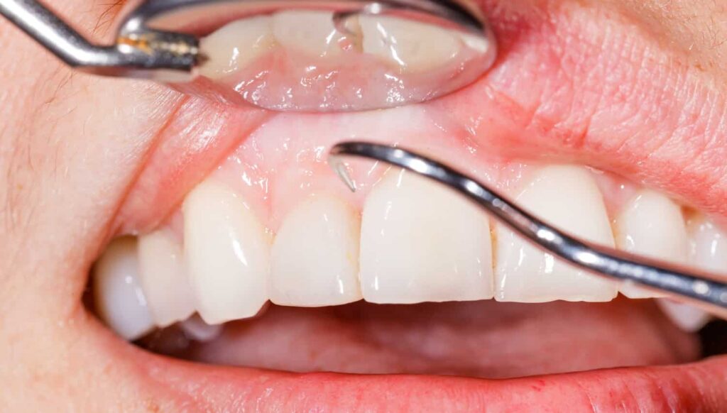 Close-up of a dental examination showing healthy gums and teeth, highlighting the importance of gum health in preventing periodontal disease.