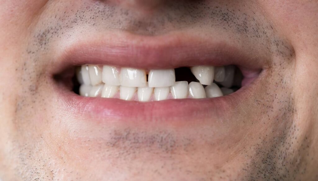 Close-up of a smiling man with a missing front tooth, illustrating the impact of tooth loss and the need for restorative dental solutions like bridges and implants.