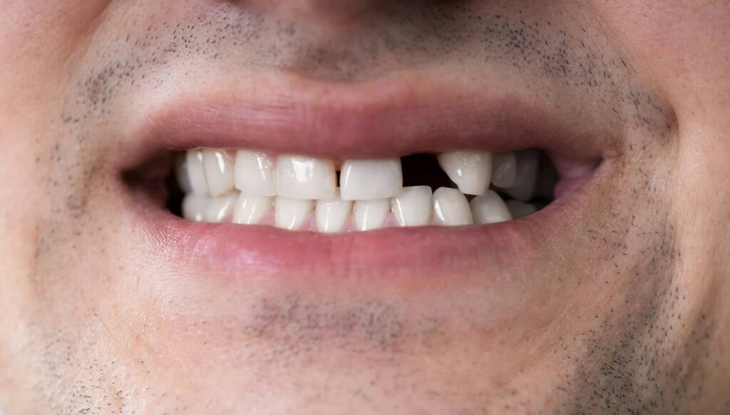 a man showing his teeth where one tooth is missing