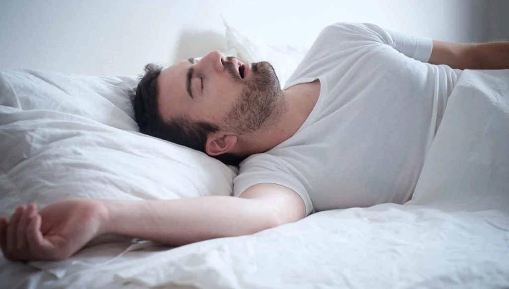 Man sleeping on white bed, mouth open, illustrating symptoms of obstructive sleep apnea related to dentistry.