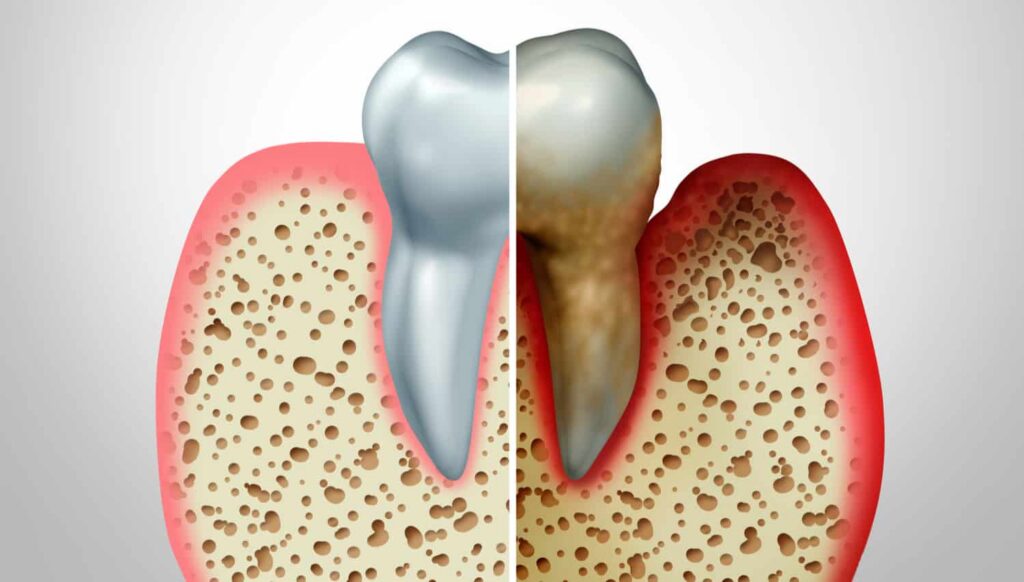 Illustration comparing healthy tooth structure and dental bone loss, highlighting differences in bone density and gum health, relevant to dental health discussions.