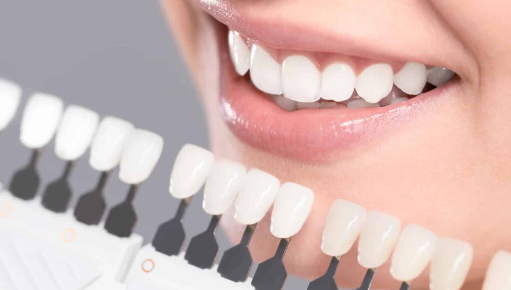 Smiling woman showcasing bright white teeth alongside a shade guide for teeth whitening options.
