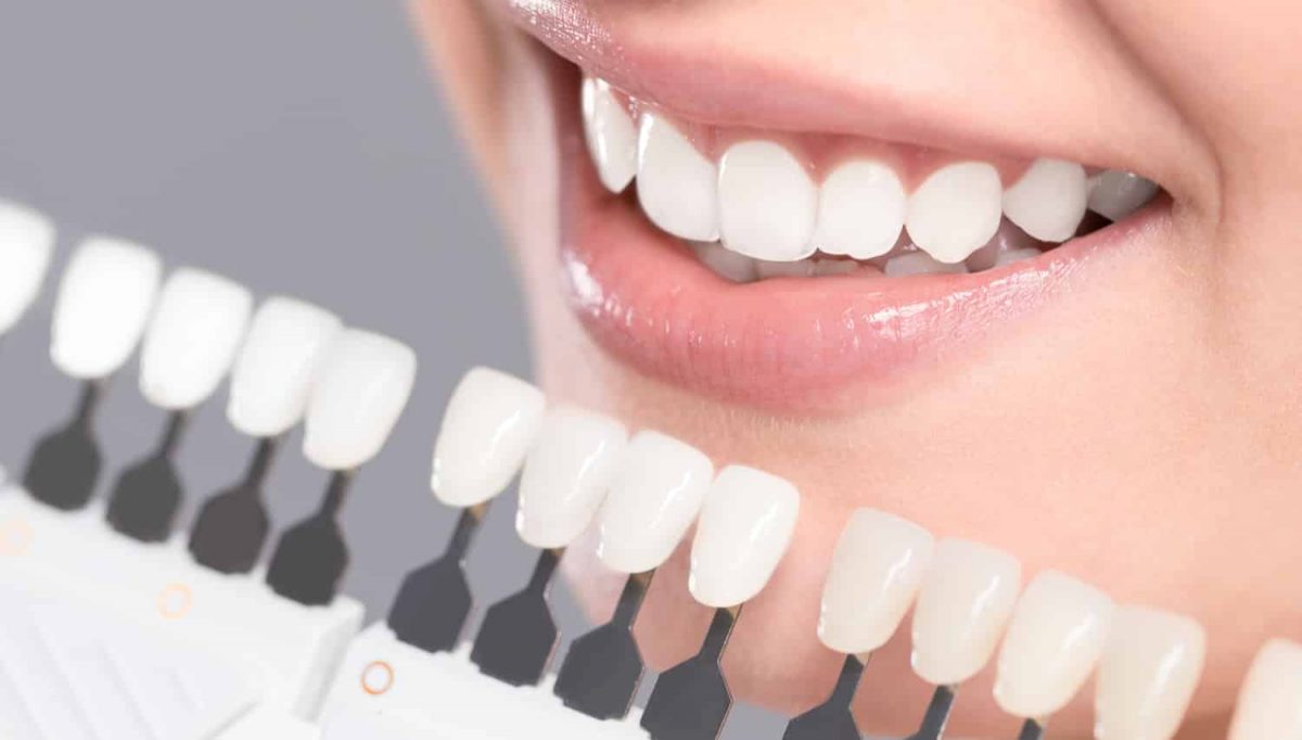 Options for Whitening Your Teeth