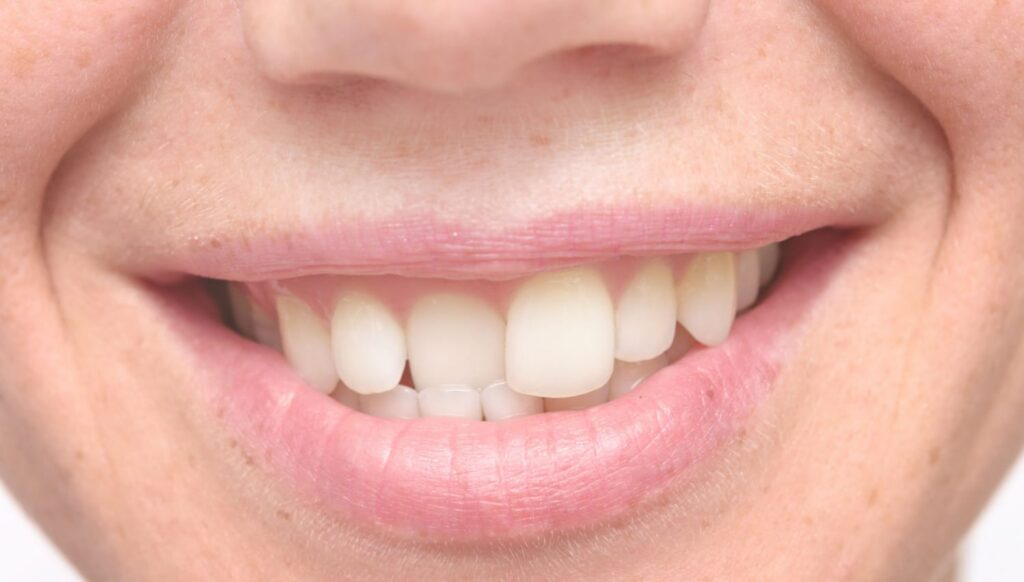 Close-up of a smiling mouth showcasing straight, white teeth, emphasizing dental health and potential orthodontic treatments like Invisalign.