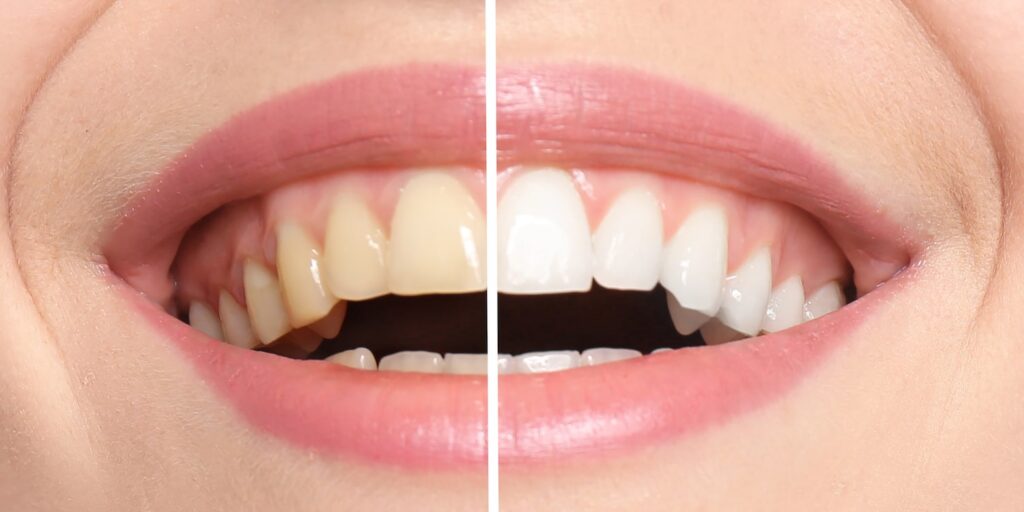 Close-up of a smiling person showing a side-by-side comparison of teeth before and after whitening treatment, highlighting the contrast between yellowed and bright white teeth, relevant to in-office and at-home teeth whitening options.