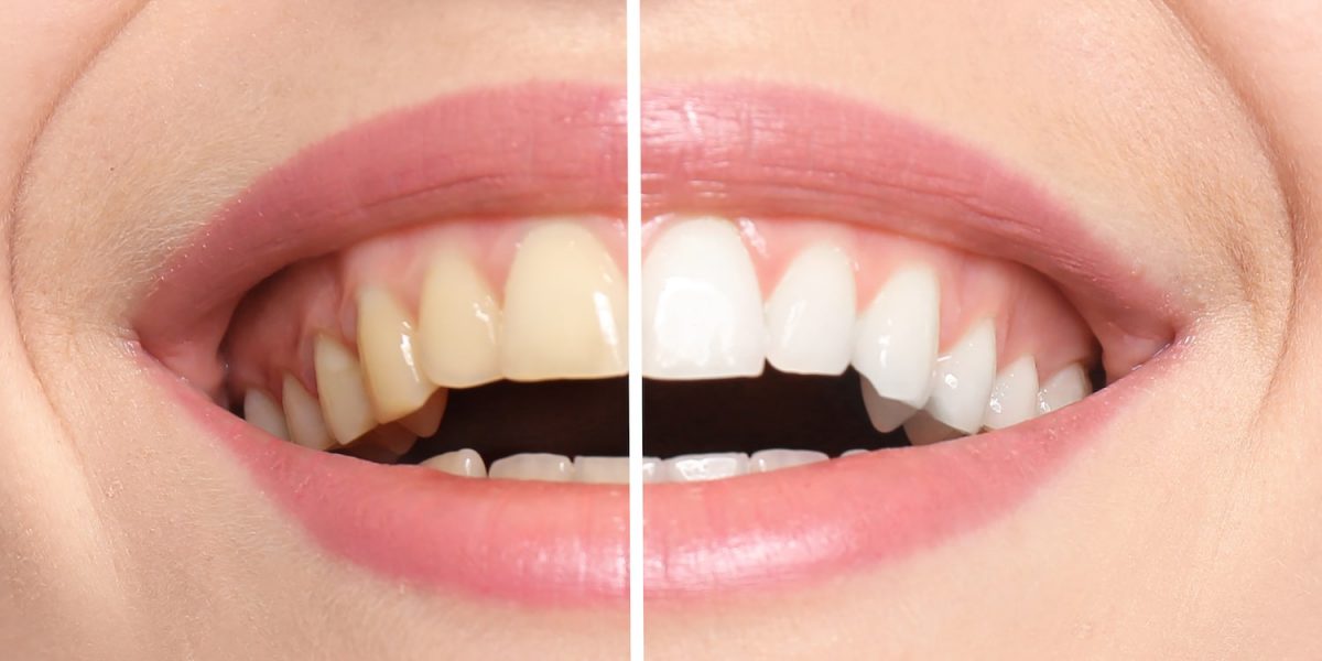 In-Office Vs At-Home Teeth Whitening