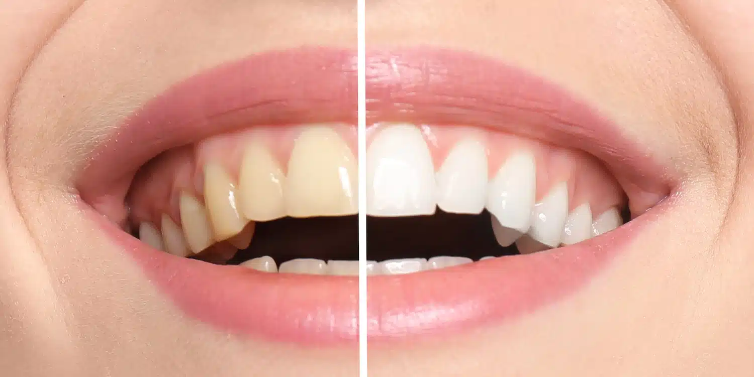 before and after results of teeth whitening at smith dentalworks