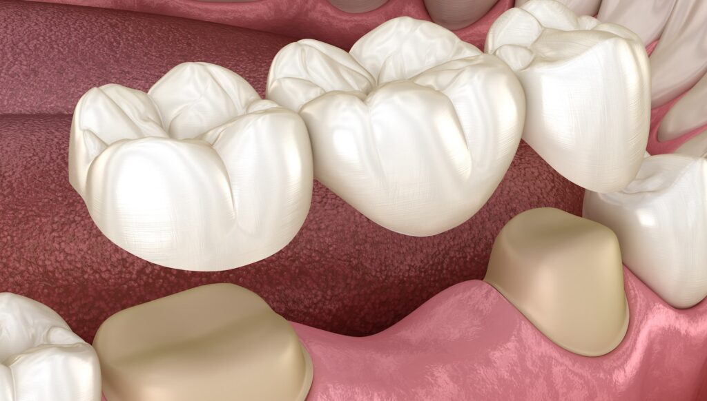 Close-up of dental bridge and crowns illustrating reconstructive dentistry techniques for restoring damaged teeth and enhancing oral aesthetics.