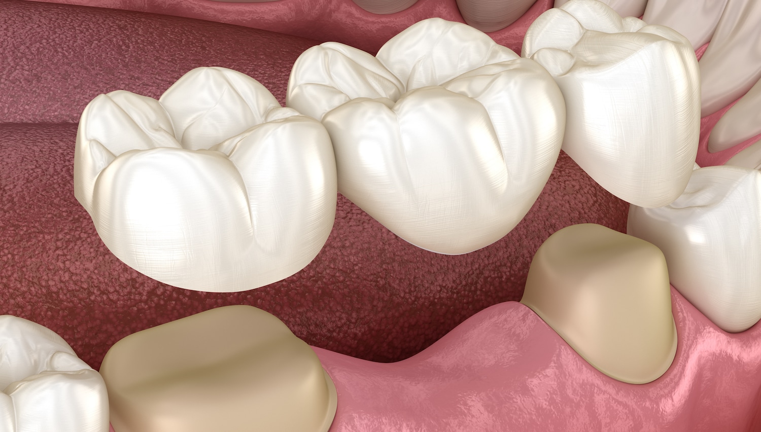 The Life-Changing Impact Of Reconstructive Dentistry