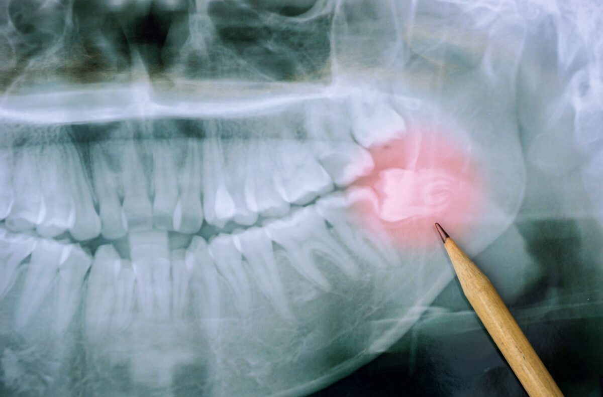 Everything You Need To Know About Wisdom Teeth: Your Complete Guide