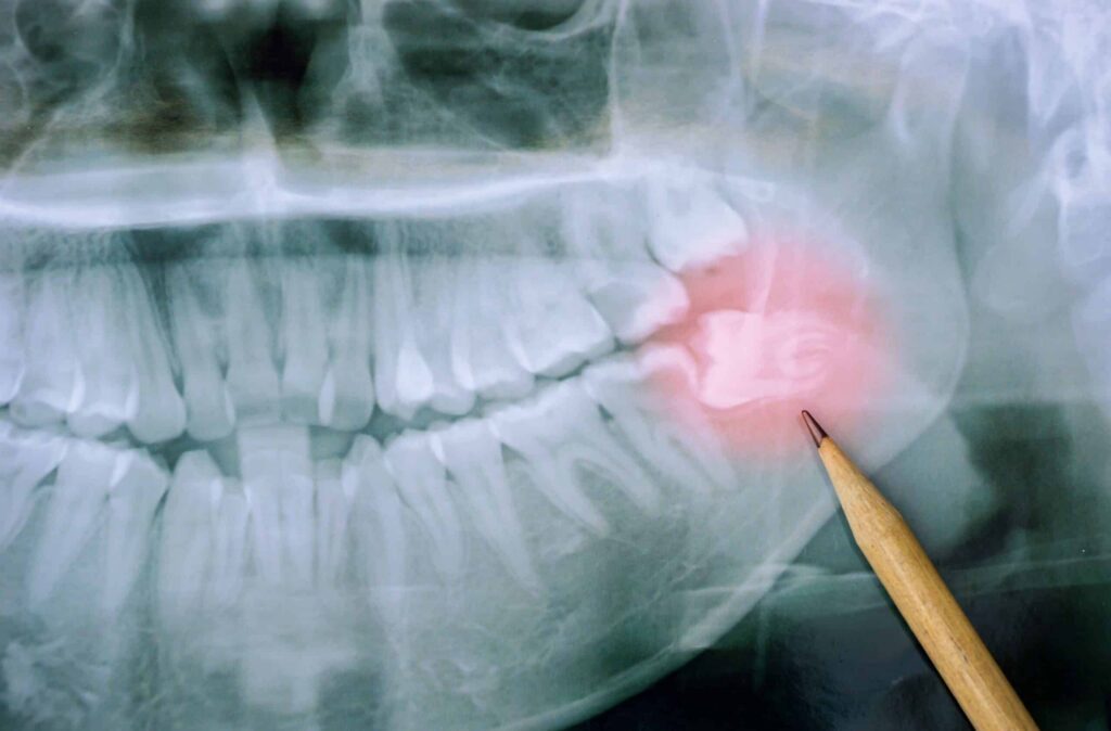 X-ray image highlighting impacted wisdom teeth with a pencil pointing to the affected area, illustrating common dental issues related to third molars.