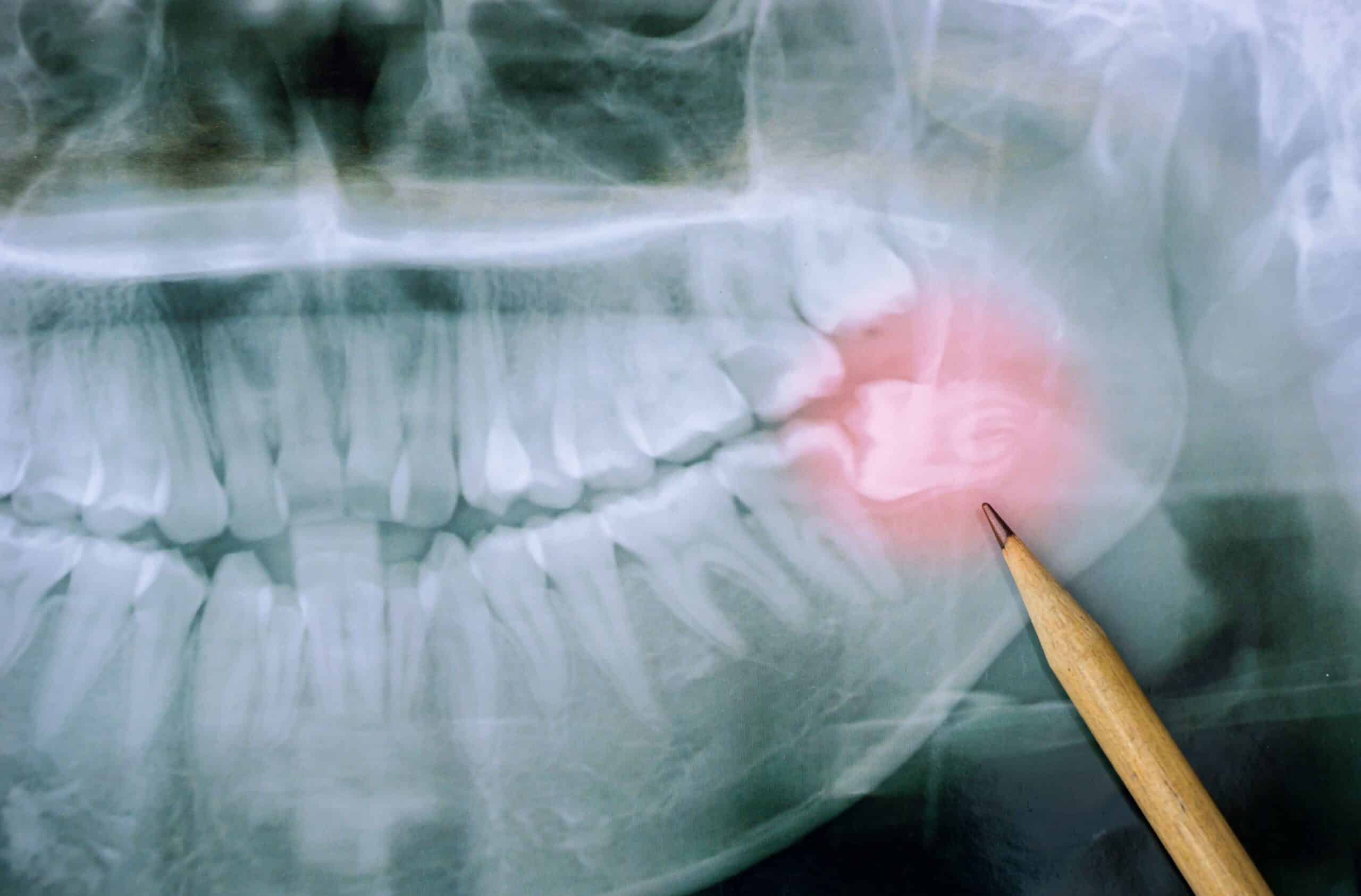 X-ray image highlighting impacted wisdom teeth with a pencil pointing to the affected area, related to dental health and extraction topics.