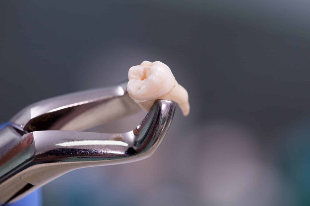 Tooth being held by dental forceps, illustrating the tooth extraction process relevant to dental care and patient education at Smith Dentalworks.