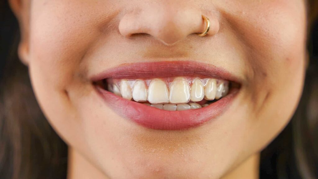 Smiling woman showcasing clear invisible braces, highlighting innovative orthodontic solutions for enhanced dental care.