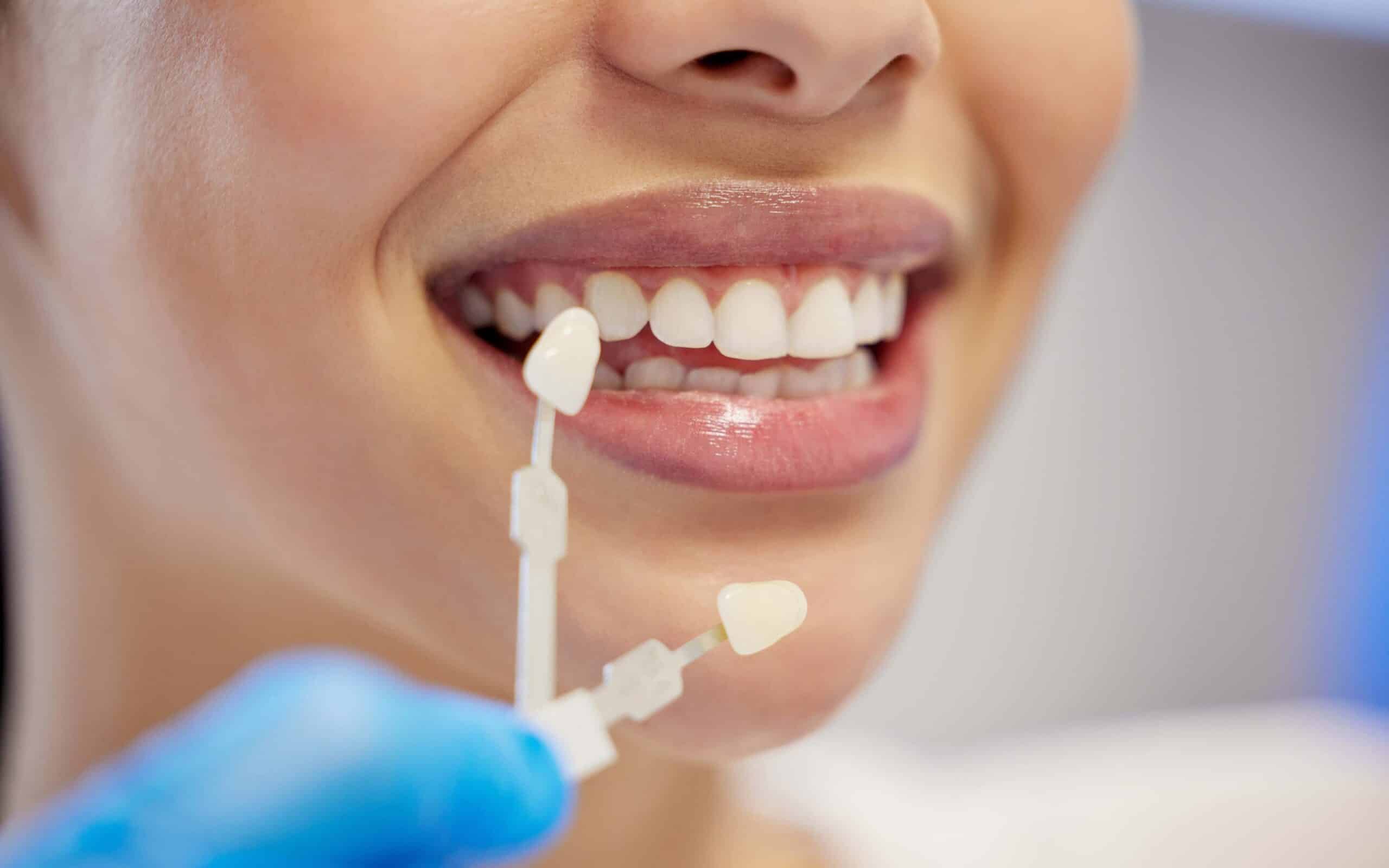 Woman smiling with bright white teeth, holding teeth whitening shade guide, illustrating cosmetic dentistry benefits.